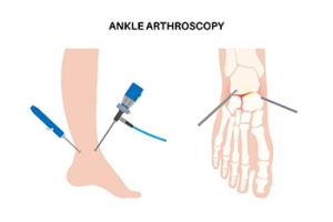 Arthroscopic Surgery for Ankle Repair