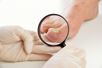 Preventing Fungal Toenail Infections