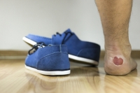Various Reasons for Blisters to Develop on the Feet