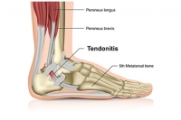 The Strong Achilles Tendon