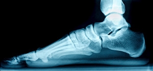 Painful Flat Feet