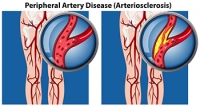 Foot Pain May Indicate PAD