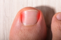 Painful Ingrown Toenails