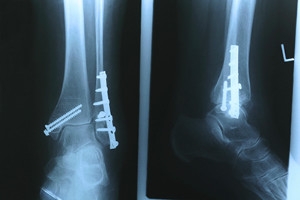 Surgery for Ankle Fractures